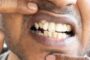 Больше нормы. Почему возникает сверхкомплектность зубов?