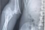 Особо опасный перелом. Хирурги Москвы спасли руку молодой гимнастке